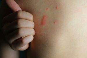 ce qui attire les punaises de lit